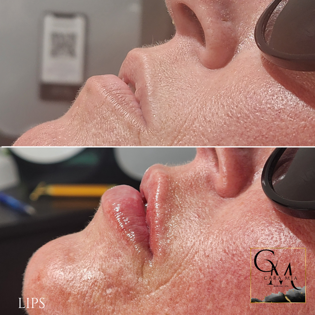 Before and after lip enhancement. Enlarged lips, side view.