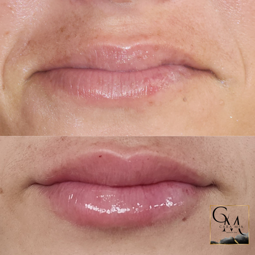 Before and after view of a person's lips. The bottom set of lips are plumper.