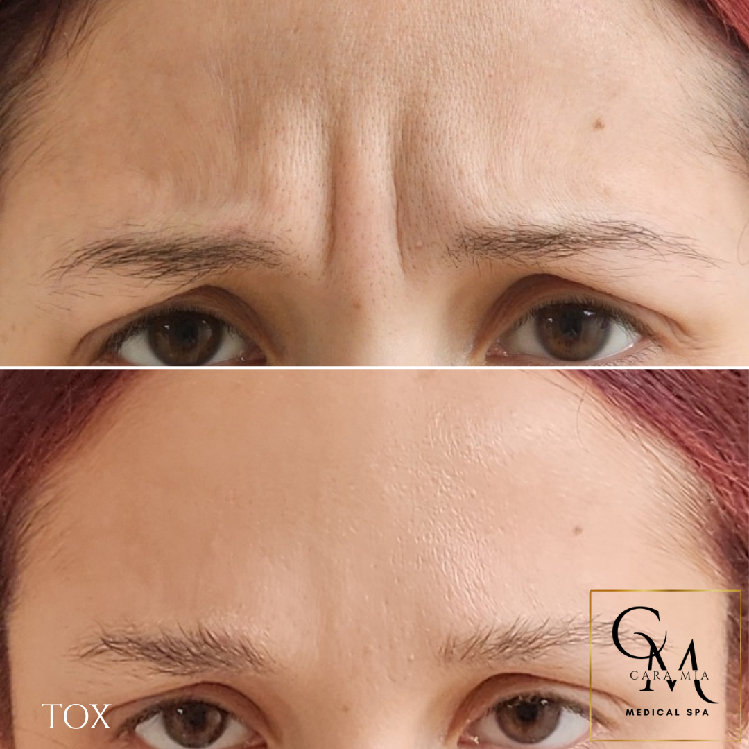 Comparison: forehead with wrinkles before, smooth after cosmetic treatment.