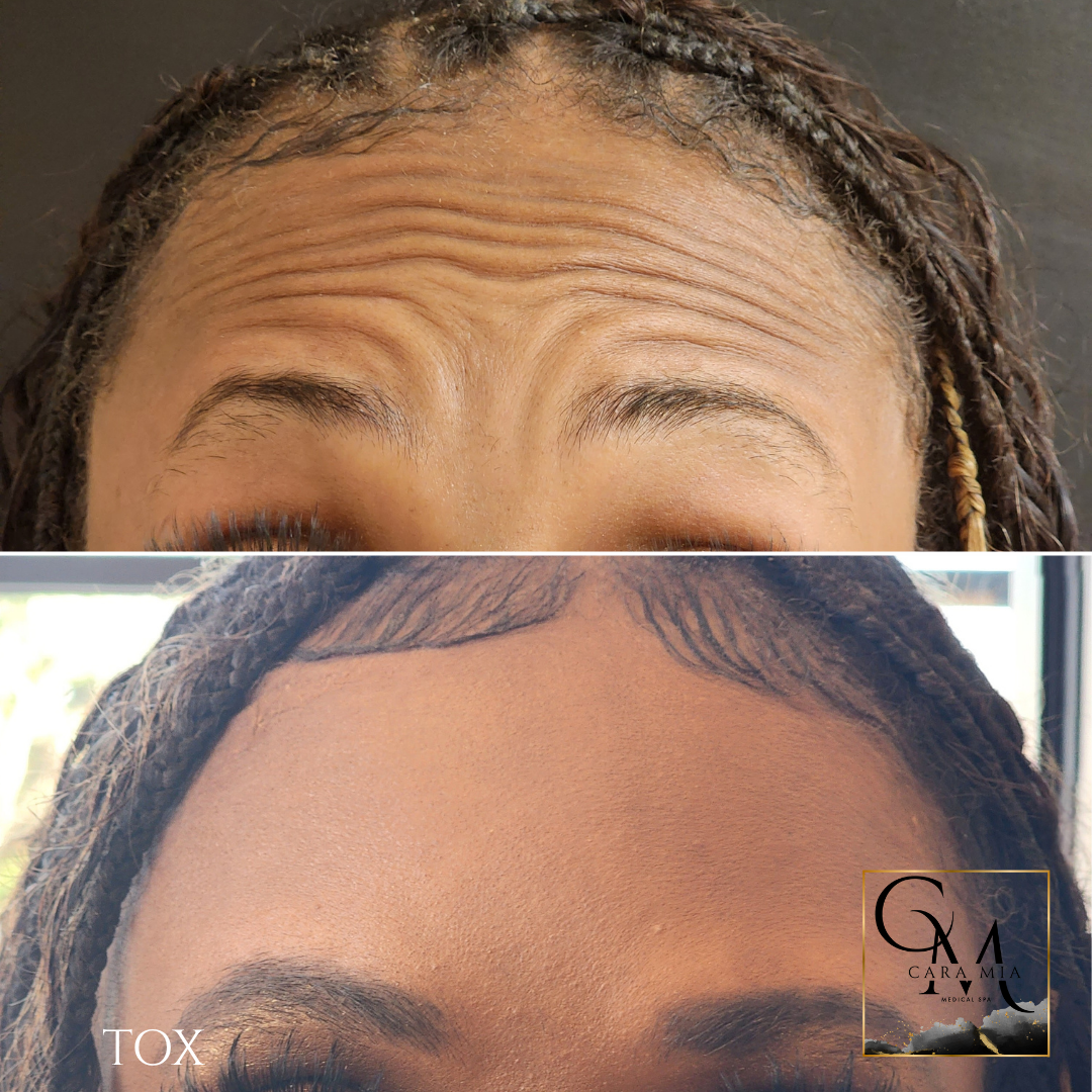Top: Forehead with prominent wrinkles. Bottom: Smoother forehead after treatment.