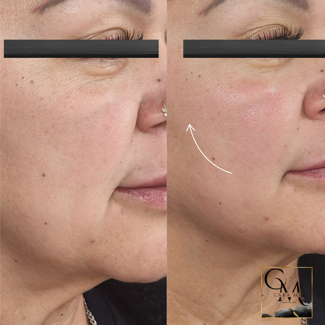 Side-by-side view of a face before and after a cosmetic procedure, showing smoother skin and a lifted cheek area.