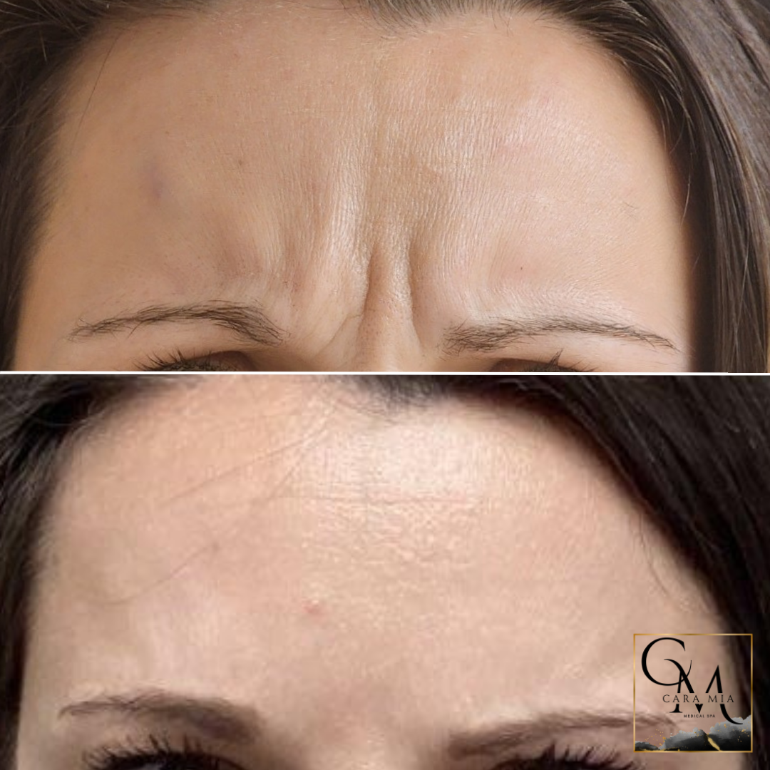 Forehead before and after treatment, showing reduction of wrinkles.