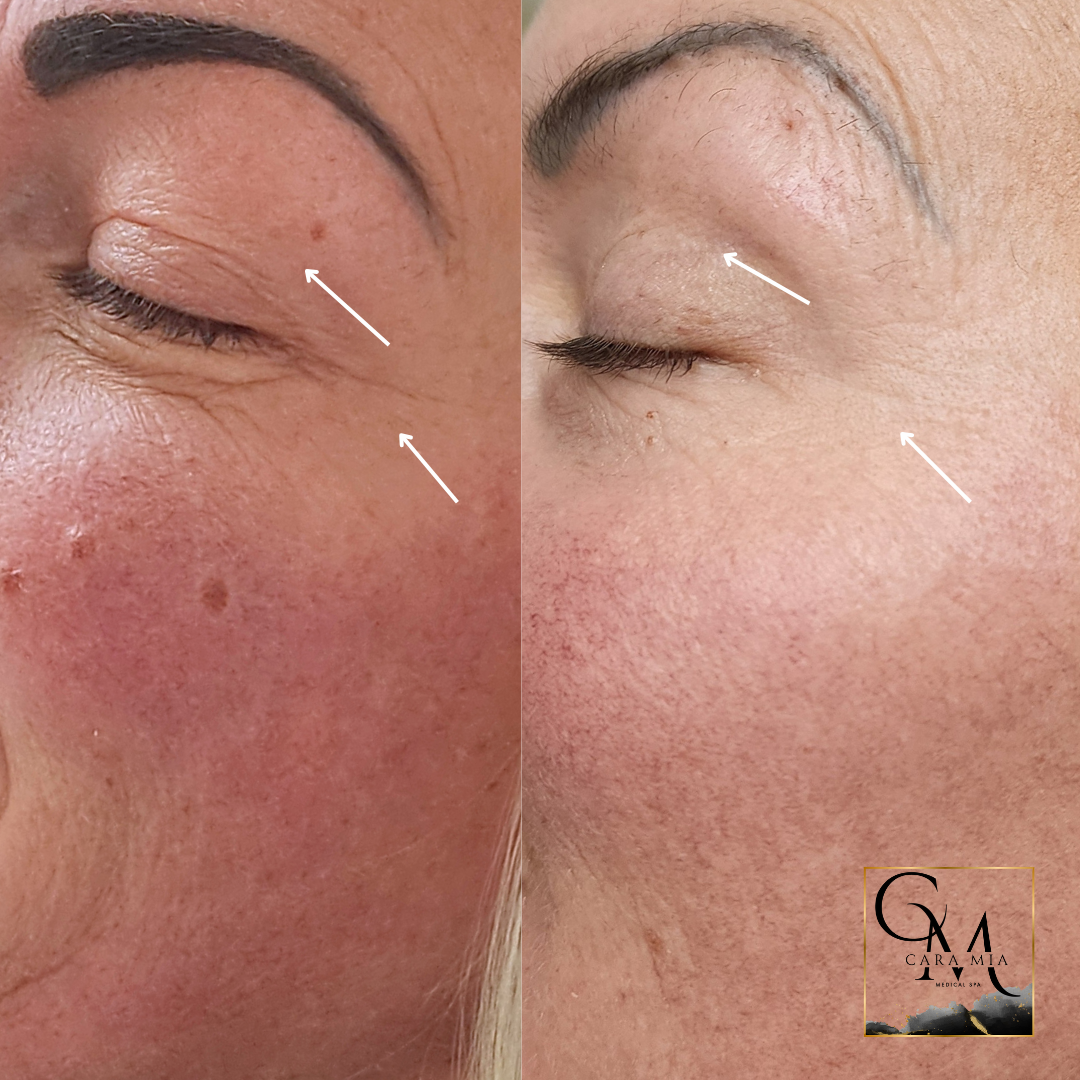 Before and after photo of a person's face. Left shows wrinkles and moles. Right shows smoother skin.