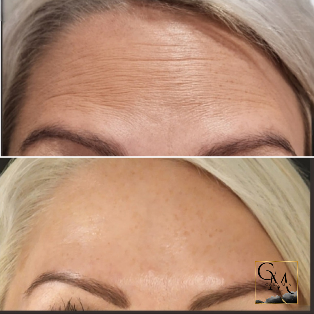 Wrinkle reduction comparison: Forehead with prominent lines before, smoother after treatment.