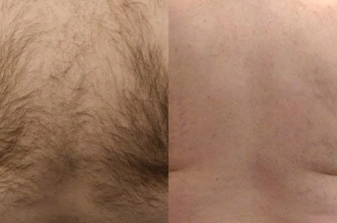 Side-by-side comparison of a hairy chest (left) and a hairless chest (right).