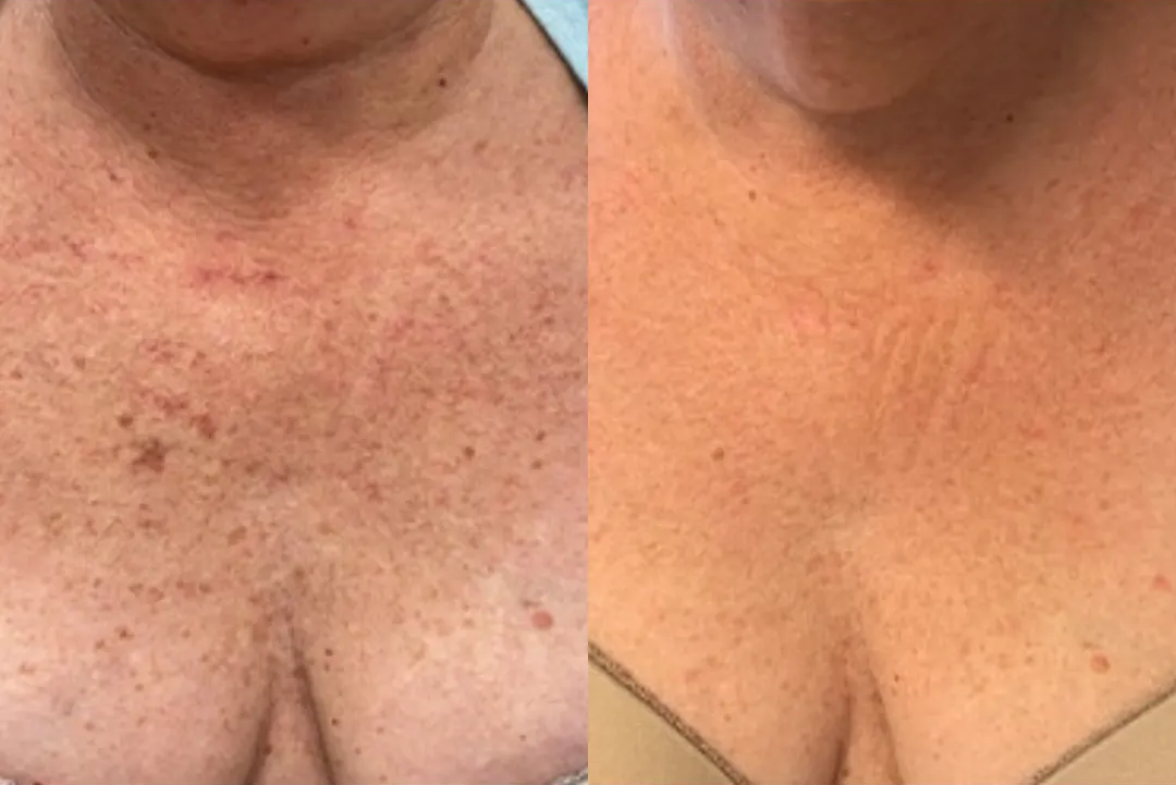 Side-by-side chest comparison. Skin shows improvement after treatment, with fewer spots and redness.