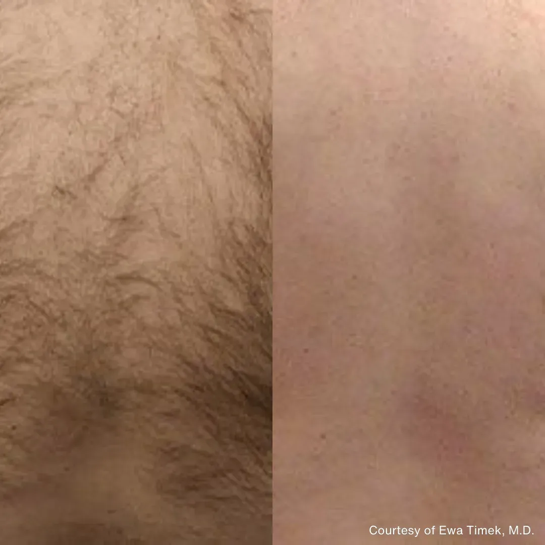 A side-by-side comparison of skin showing significant hair reduction after laser treatment on the left vs. clear skin.
