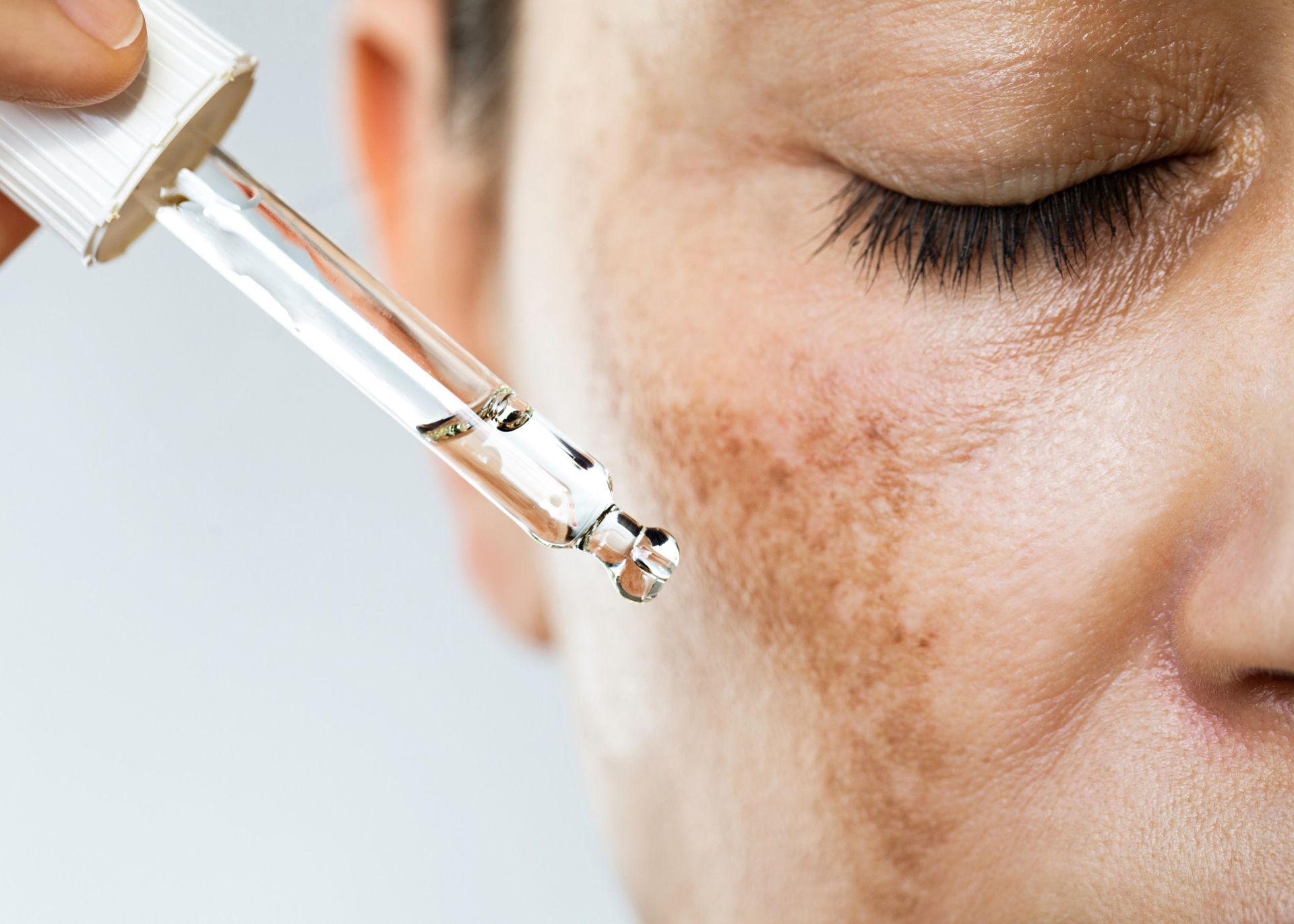 A dropper dispenses liquid onto a cheek with visible areas of skin hyperpigmentation.