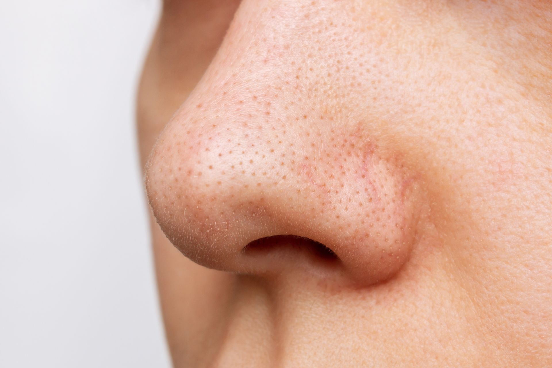 Close-up profile view of a nose with visible sebaceous filaments or blackheads on the skin surface.