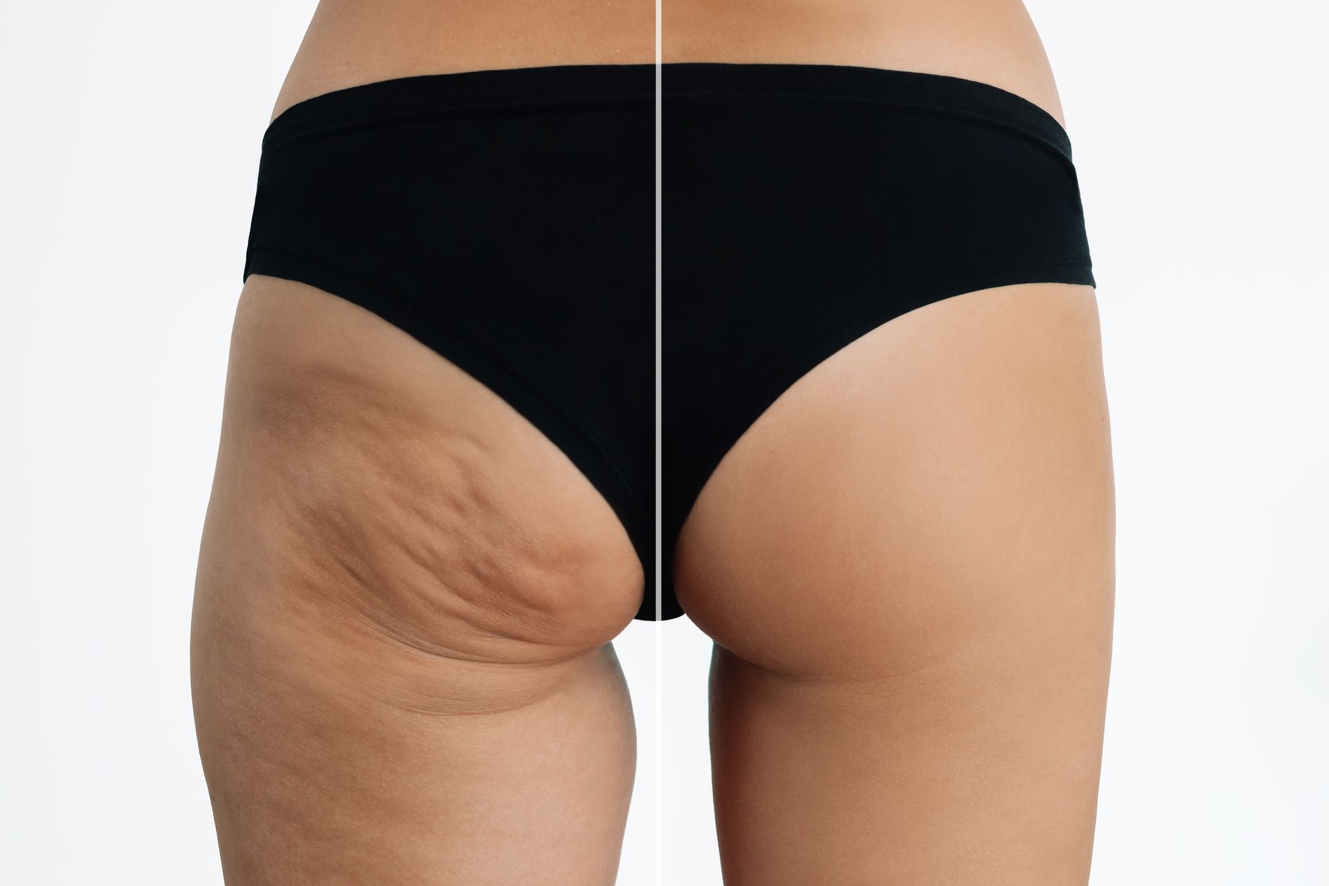 A split image comparing skin texture, showing a side with visible cellulite on the left and smoother skin on the right.