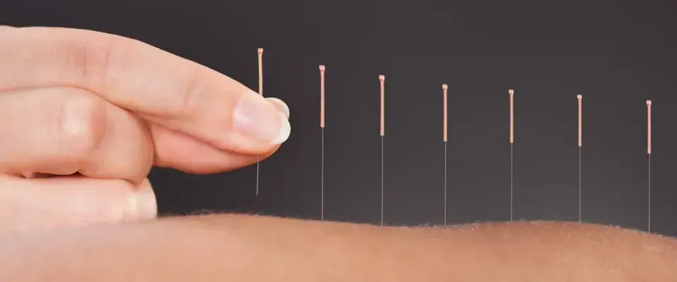 Akupunkturnåler stukket inn i huden; en hånd holder en annen nål. Mørk bakgrunn.