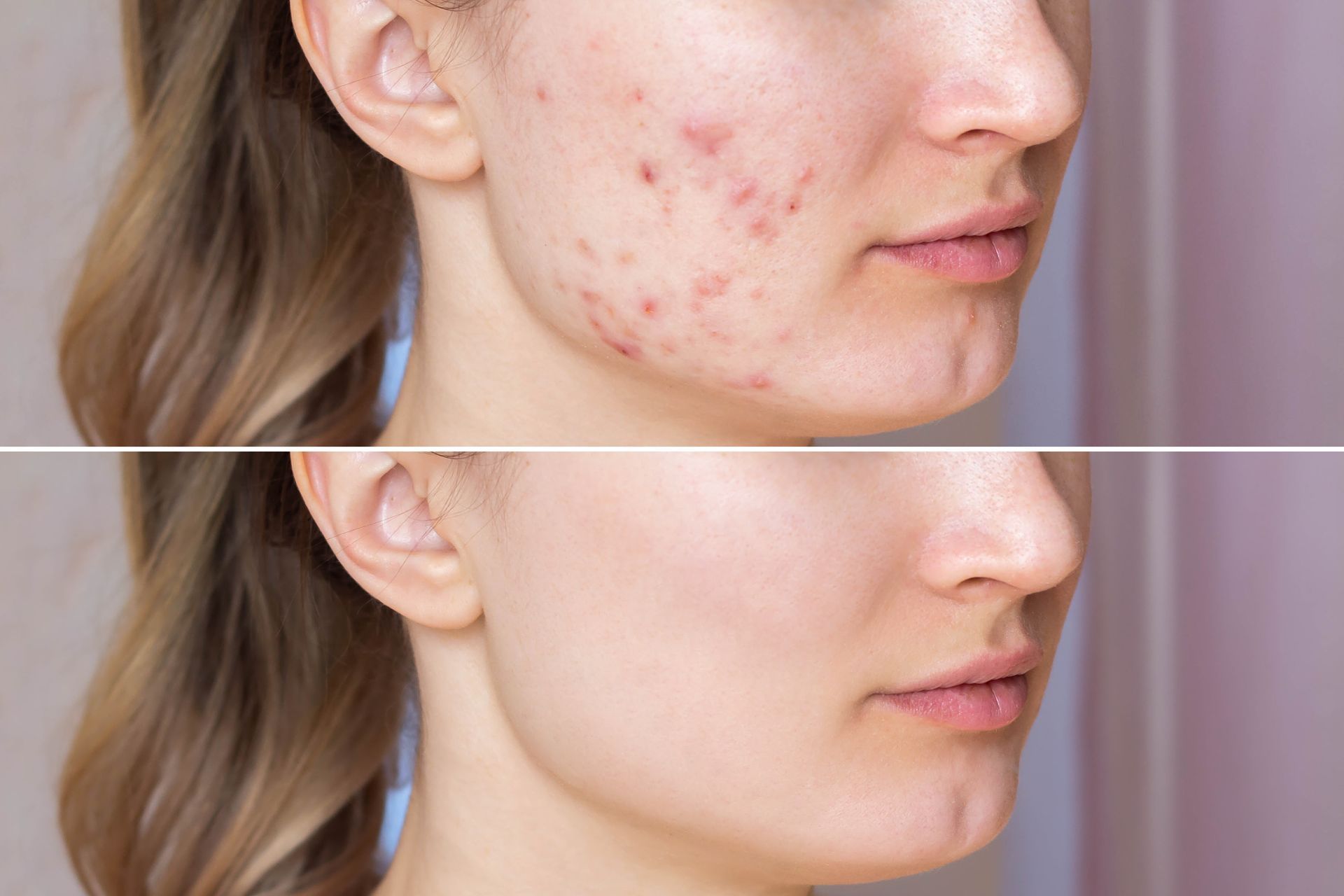 a before and after photo of a woman 's face with acne .