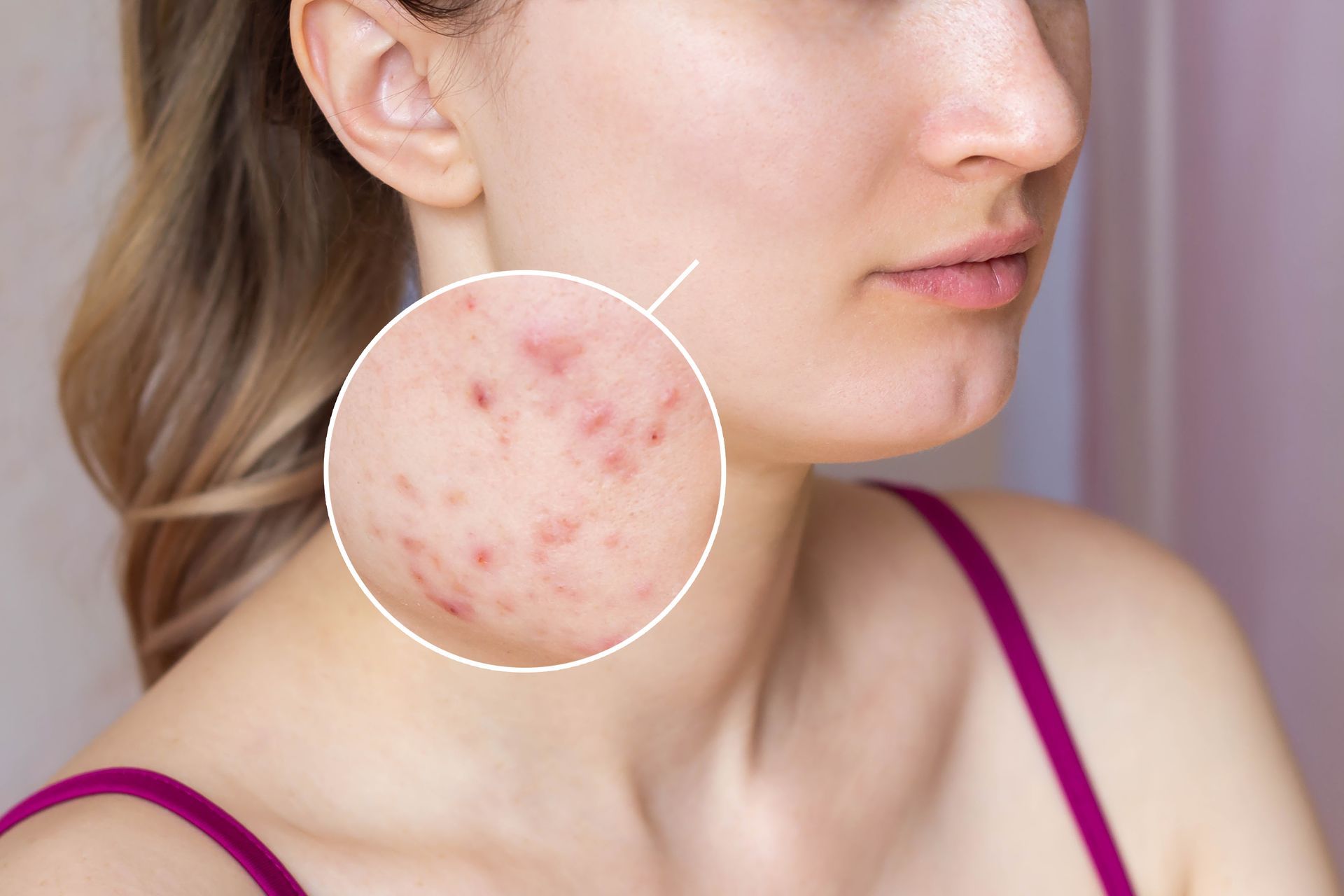 A close up of a woman 's face with acne on it.