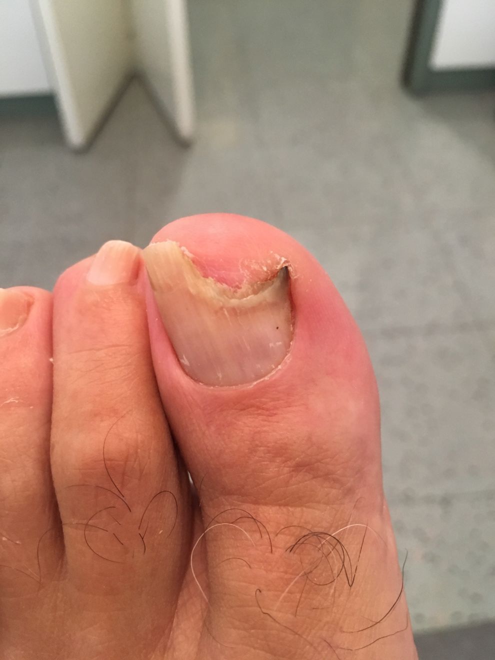 unghia dell'alluce rotta