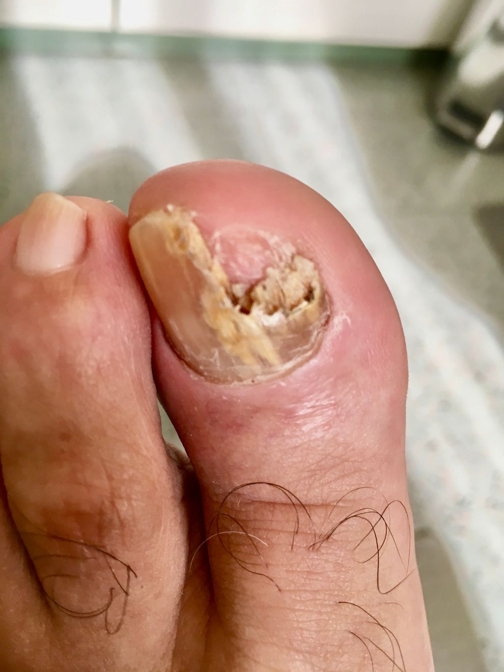 unghia del piede rotta