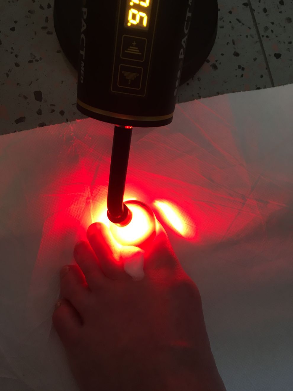 fototerapia per cura delle micosi