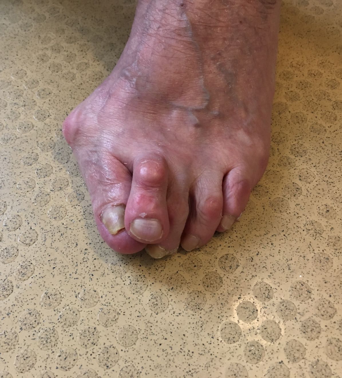 dita dei piedi con patologie