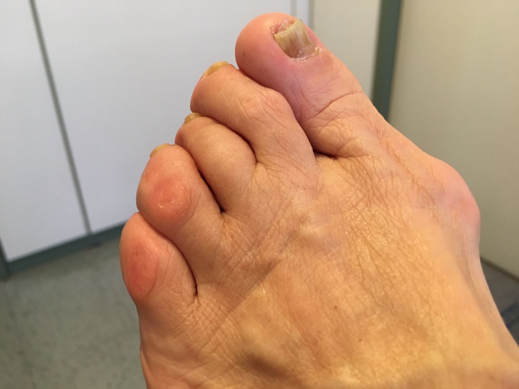 piede con patologie alle dita