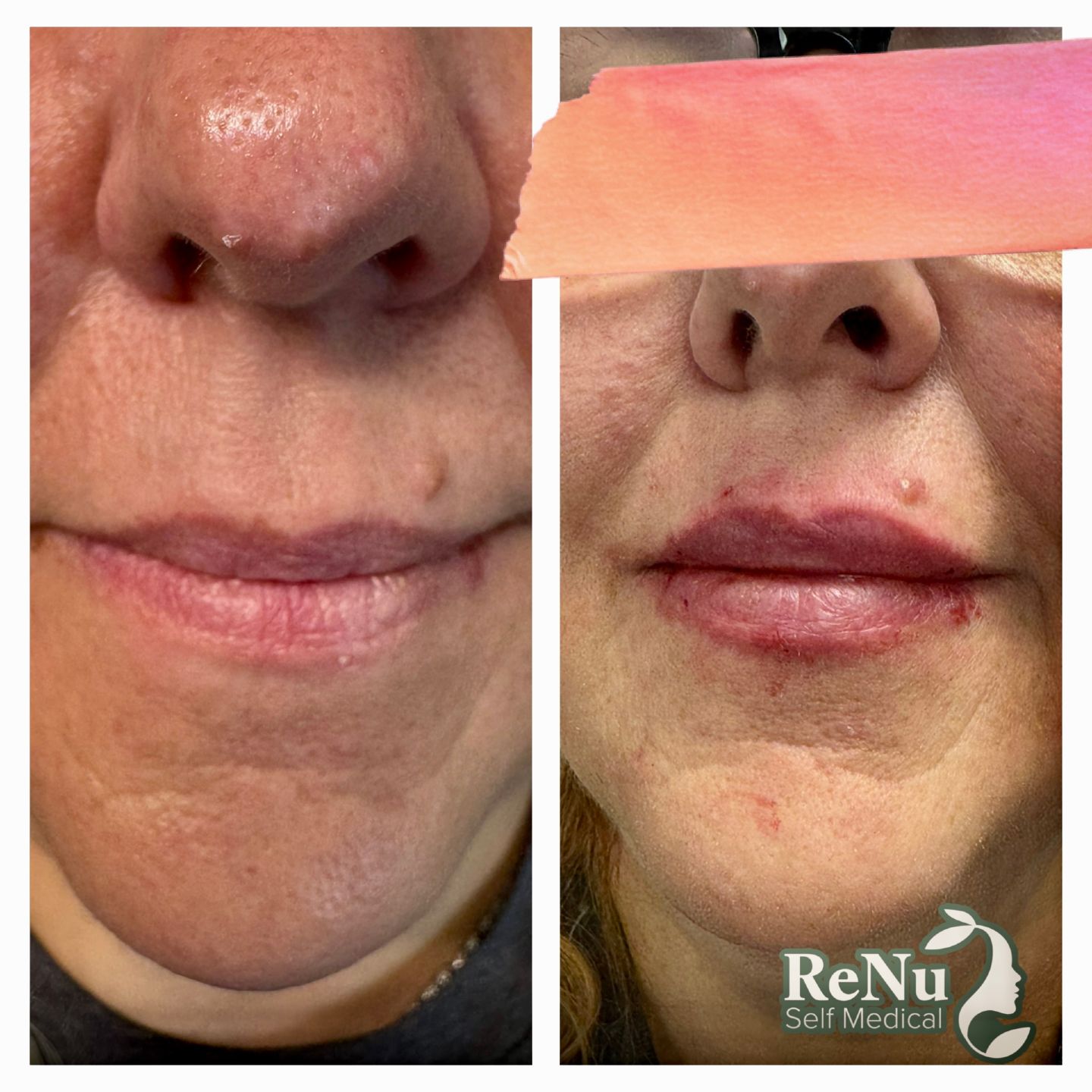Before and after photos of lips; lips appear fuller after cosmetic procedure.