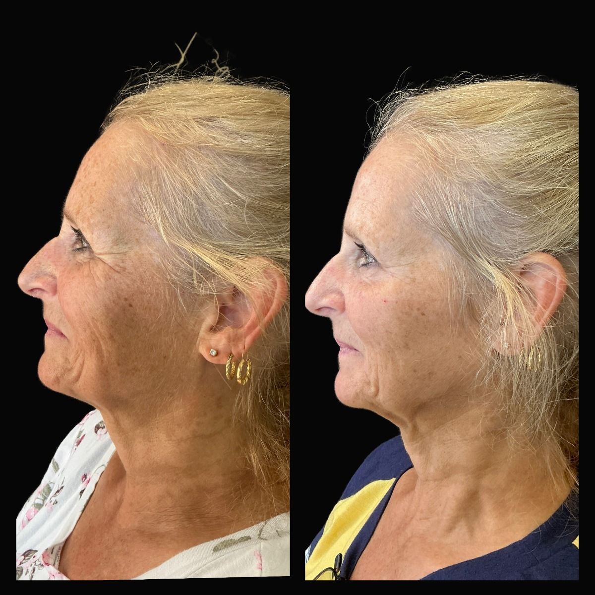 Side-by-side comparison of a person's profile before and after a cosmetic procedure. The skin appears smoother in the after photo.