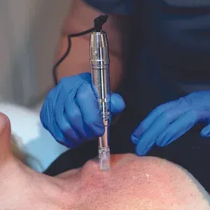 Person receiving microneedling treatment on the face, held by gloved hands.