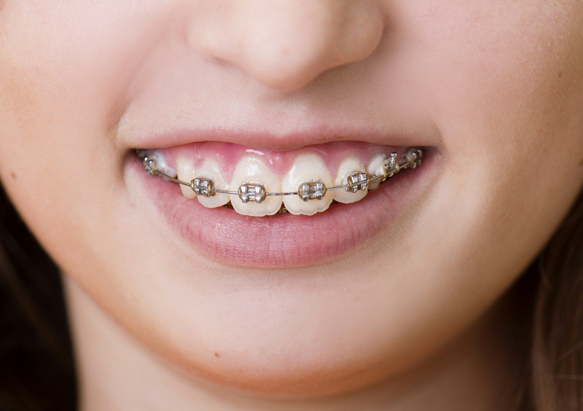 braces care