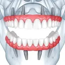 dental implants