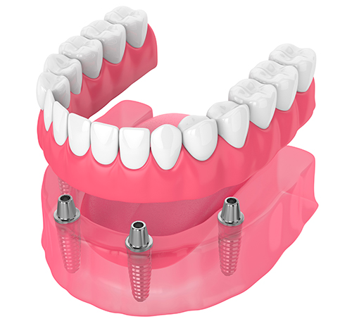 Snap in denture implant image