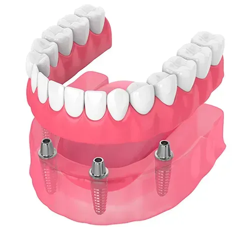 dental implants