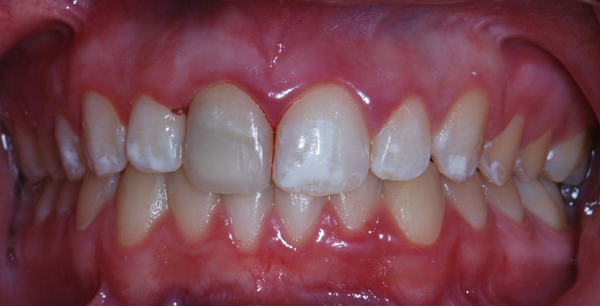 Close-up of teeth in a mouth, showing slight discoloration and redness of gums.