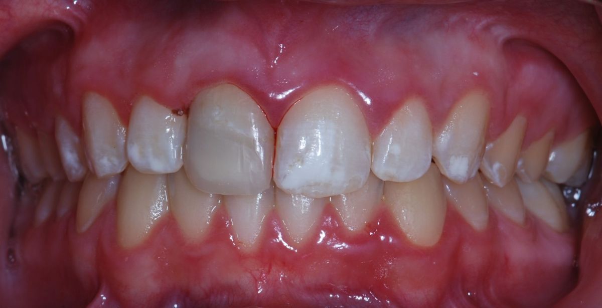 A close up of a person 's teeth with white teeth