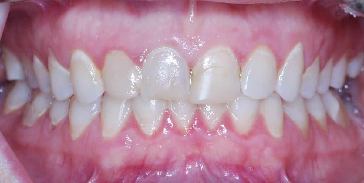 A close up of a person 's teeth with a few white spots on them.
