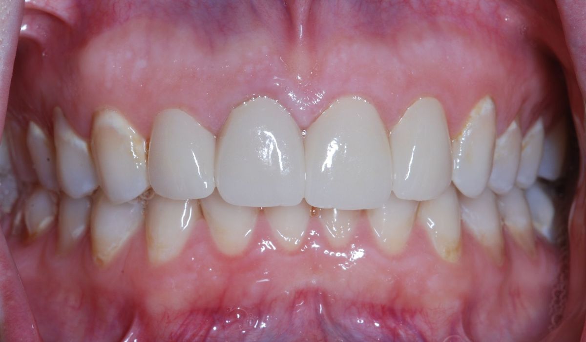 A close up of a person 's teeth with white teeth
