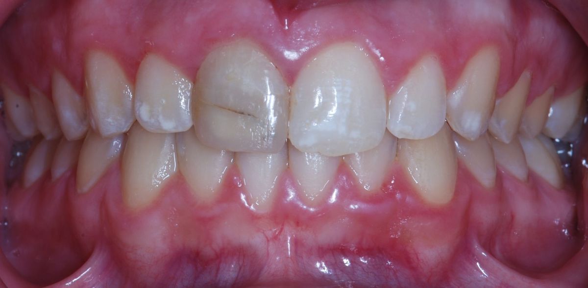 A close up of a person 's teeth with a broken tooth.