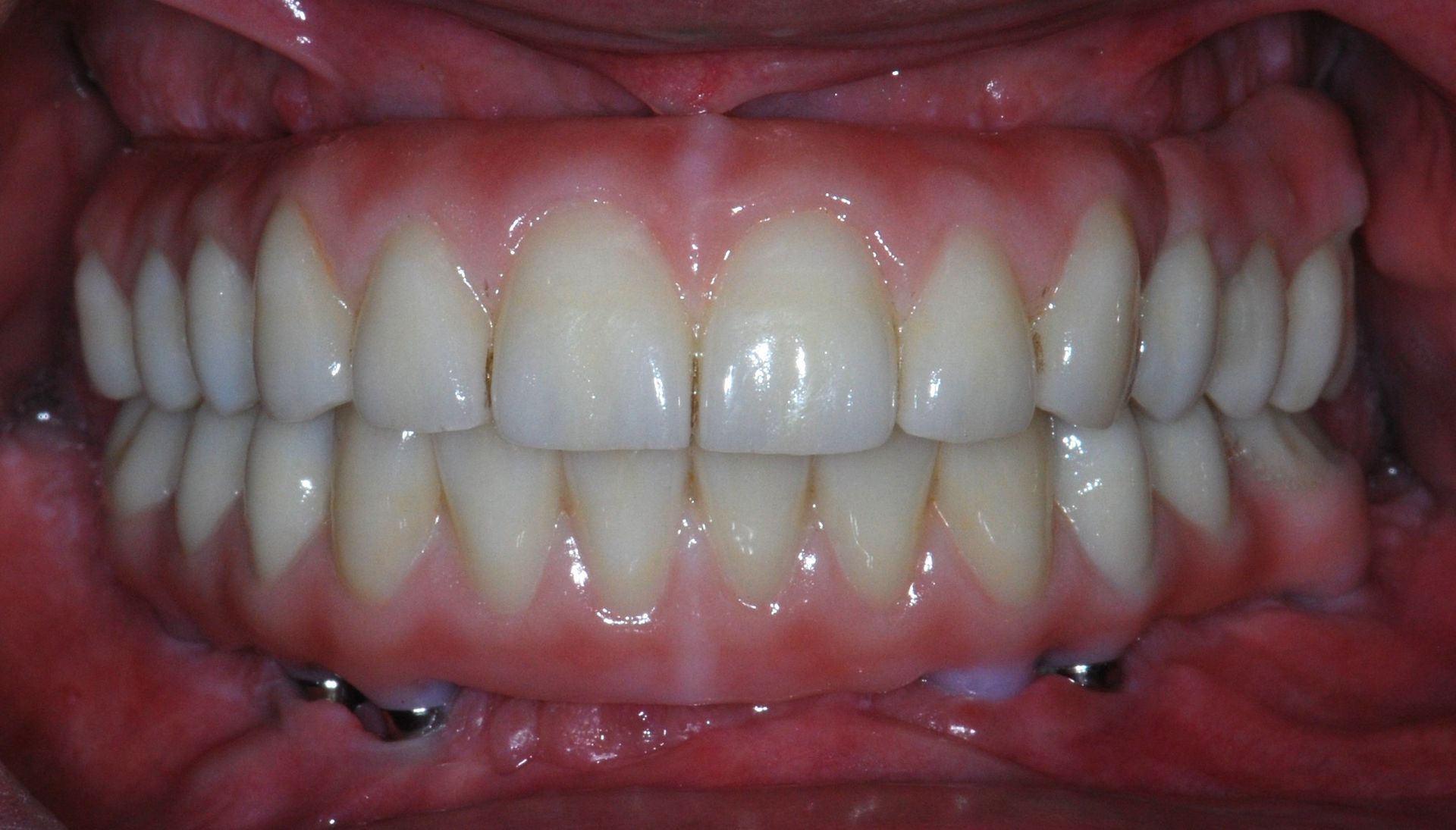 Close-up of a person's mouth, showing healthy teeth and gums. Teeth are white, gums are pink, and the overall tone is natural.