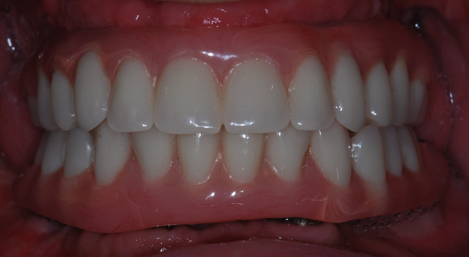 Close-up of healthy teeth, gums, and mouth. White teeth are aligned in a slightly arched row. Gums are red.