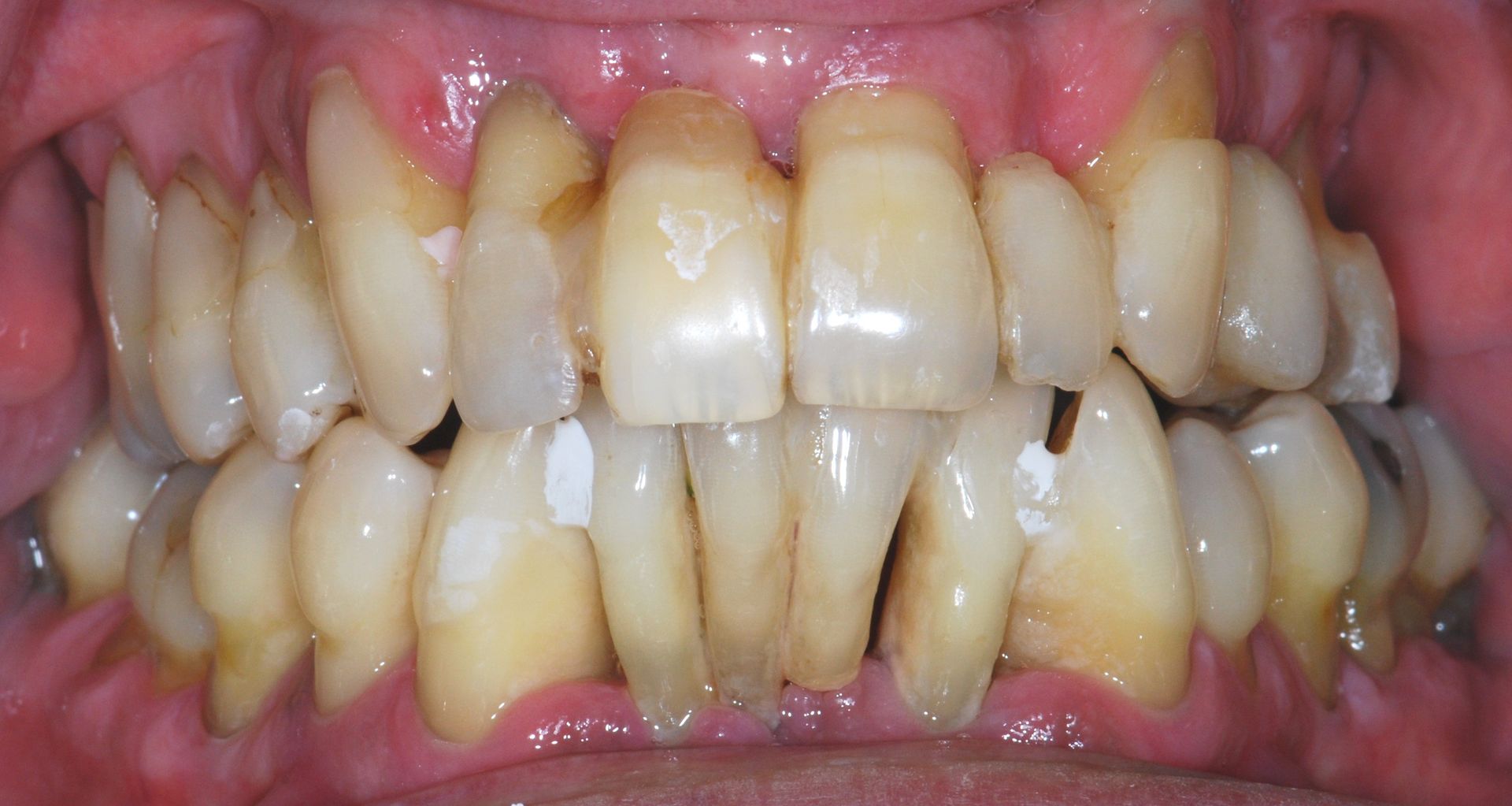 Close-up of teeth in a mouth, showing healthy gums and evenly aligned, natural-colored teeth.