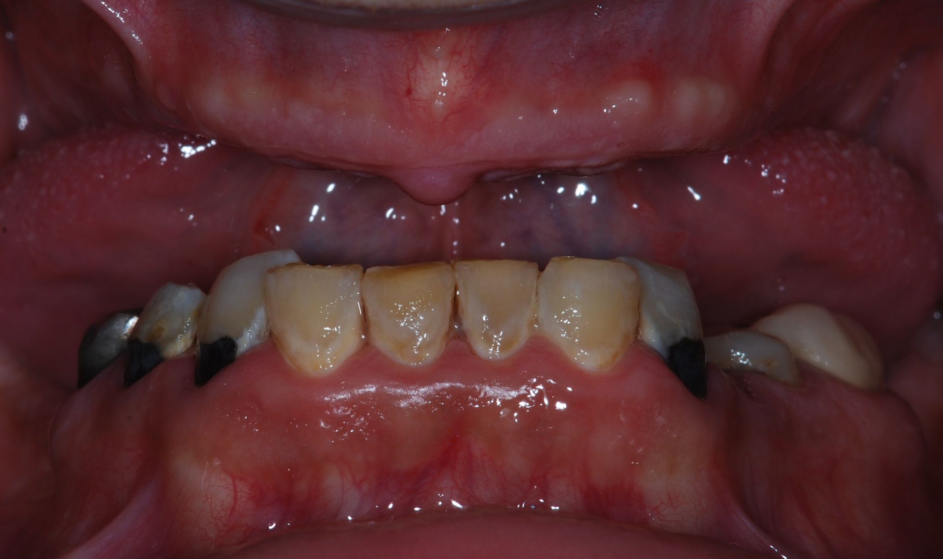 Close-up of a mouth. Visible are teeth, gums, and roof of the mouth. Some teeth have dark fillings and discoloration.
