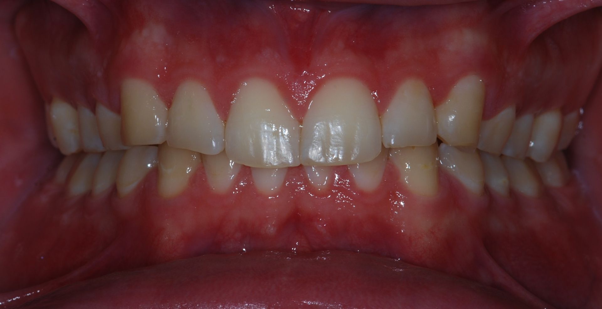 Close-up of a person's teeth, showing straight but slightly yellowed teeth. Pink gums visible.