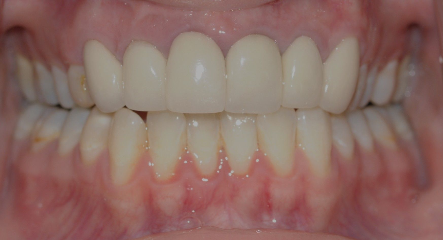 Close-up of a person's teeth. The top teeth are bright white, and the lower teeth are more yellow. The gums are pink.