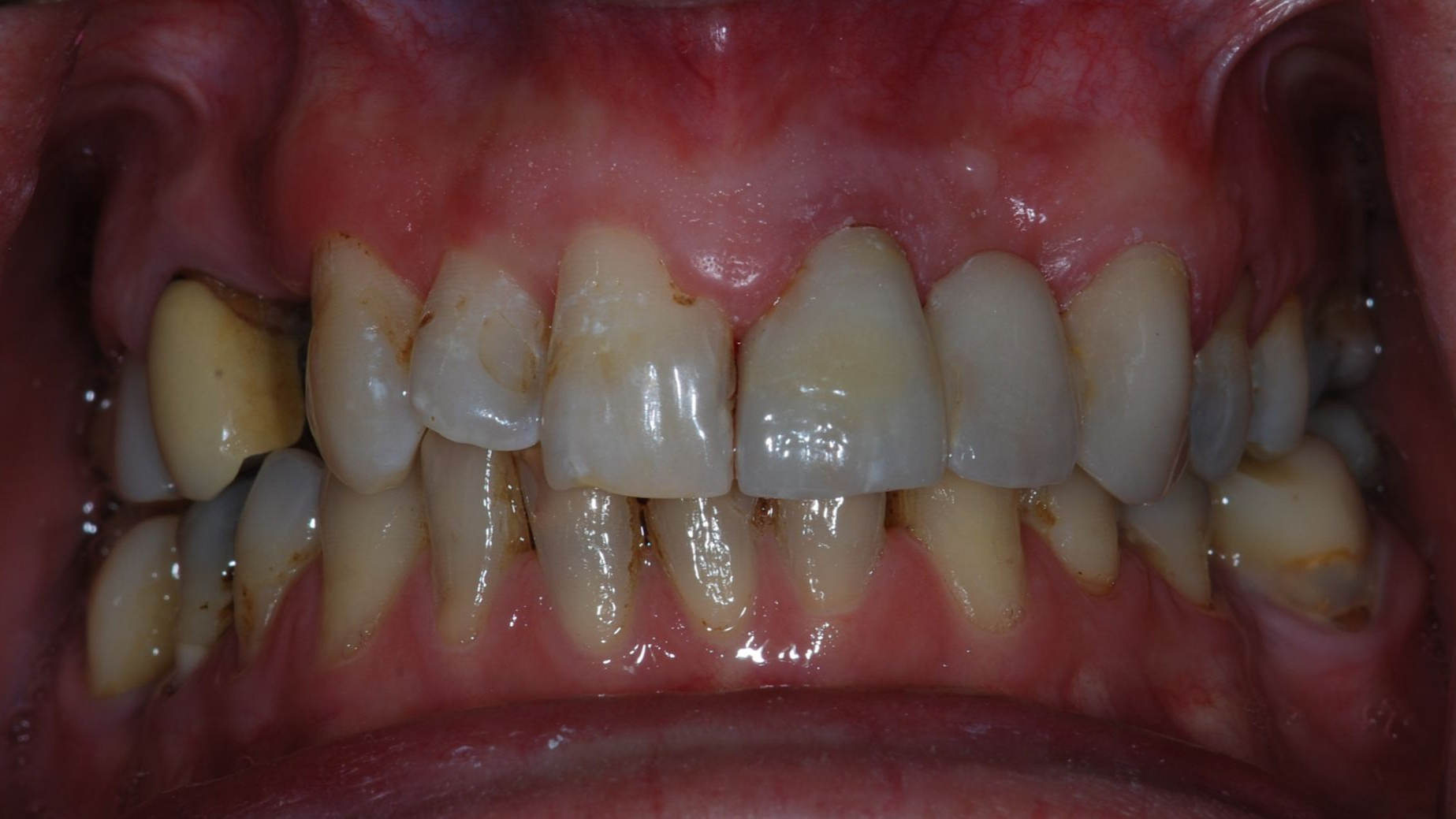 Close-up of human teeth showing yellowing, discoloration, and signs of dental decay; pink gums.