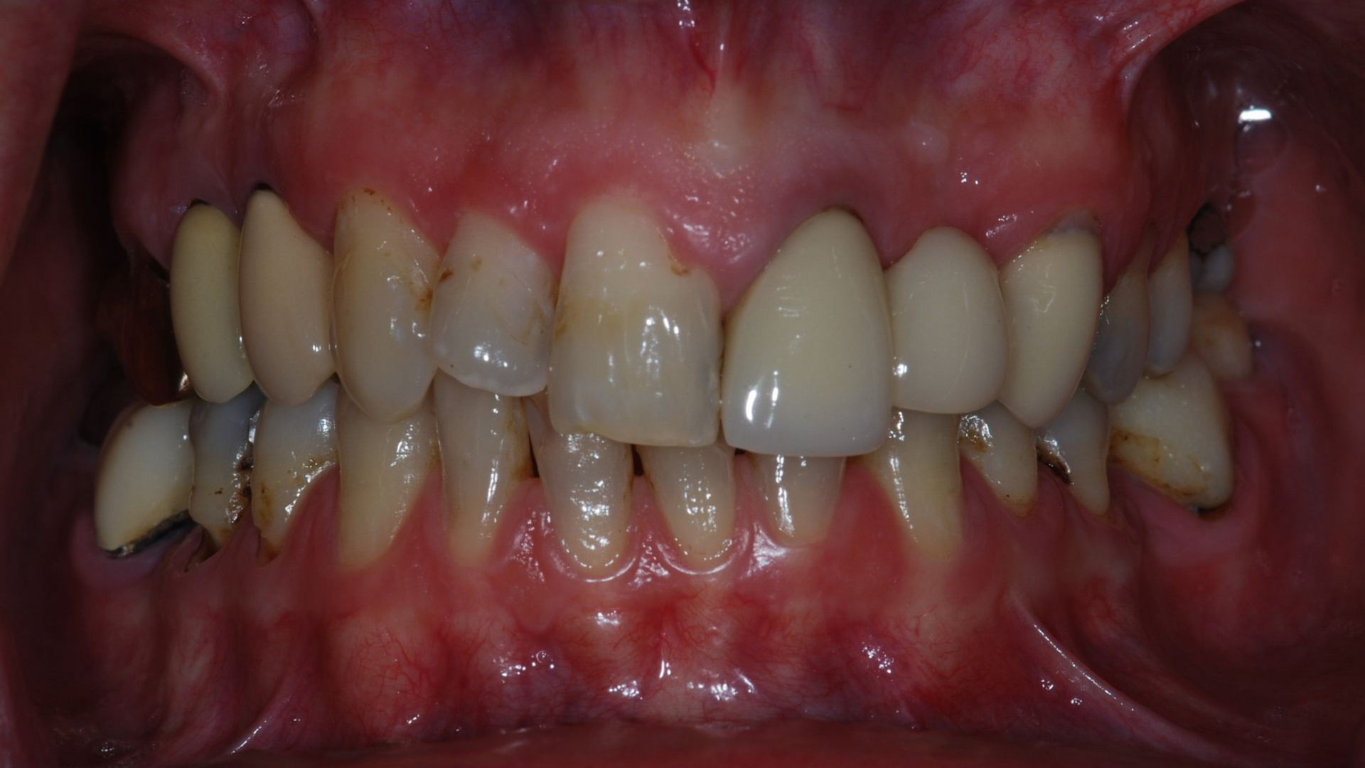 Close-up of teeth with some yellowing, and inflammation of the gums in a mouth.