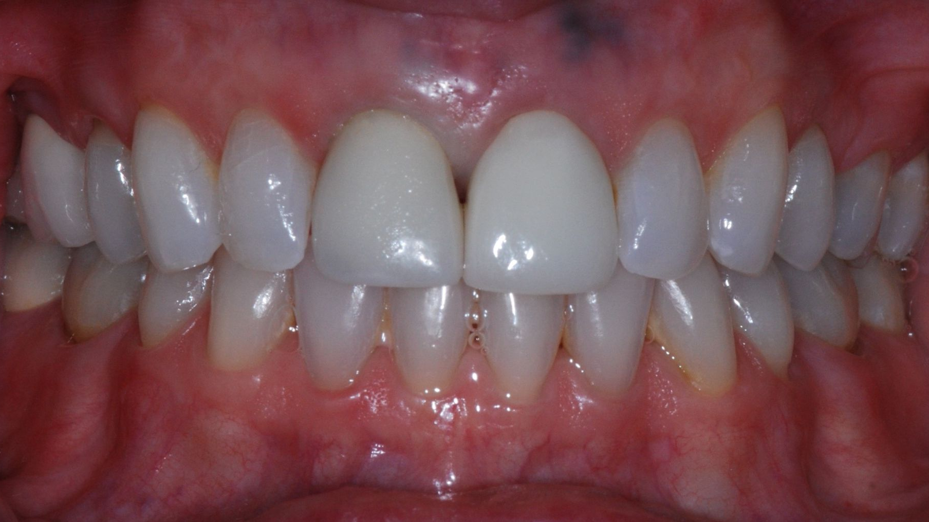 Close-up of teeth with dental work, including two front teeth crowns, in a healthy, pink mouth.