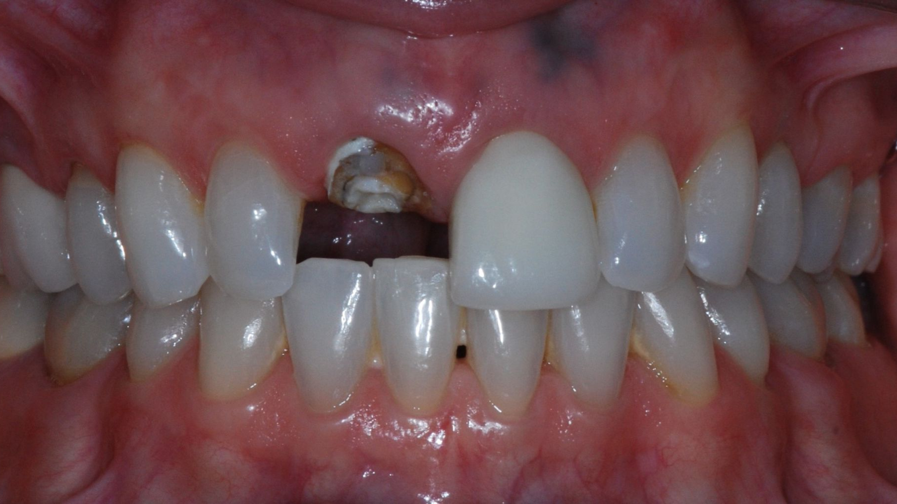Close-up of mouth, missing central incisor with exposed roots and adjacent tooth with crown. Other teeth visible.