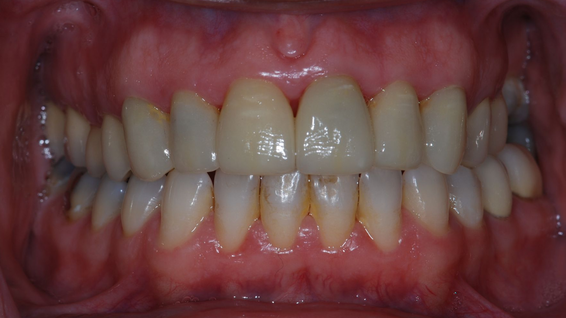 Close-up of a person's mouth, showing healthy teeth and gums. Teeth are white, gums are pink, and the overall tone is natural.
