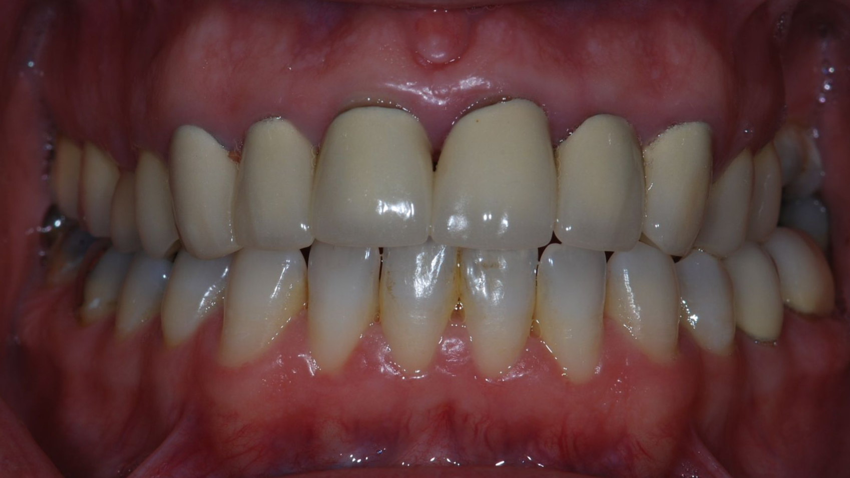Close-up of teeth in a mouth, showing healthy gums and evenly aligned, natural-colored teeth.