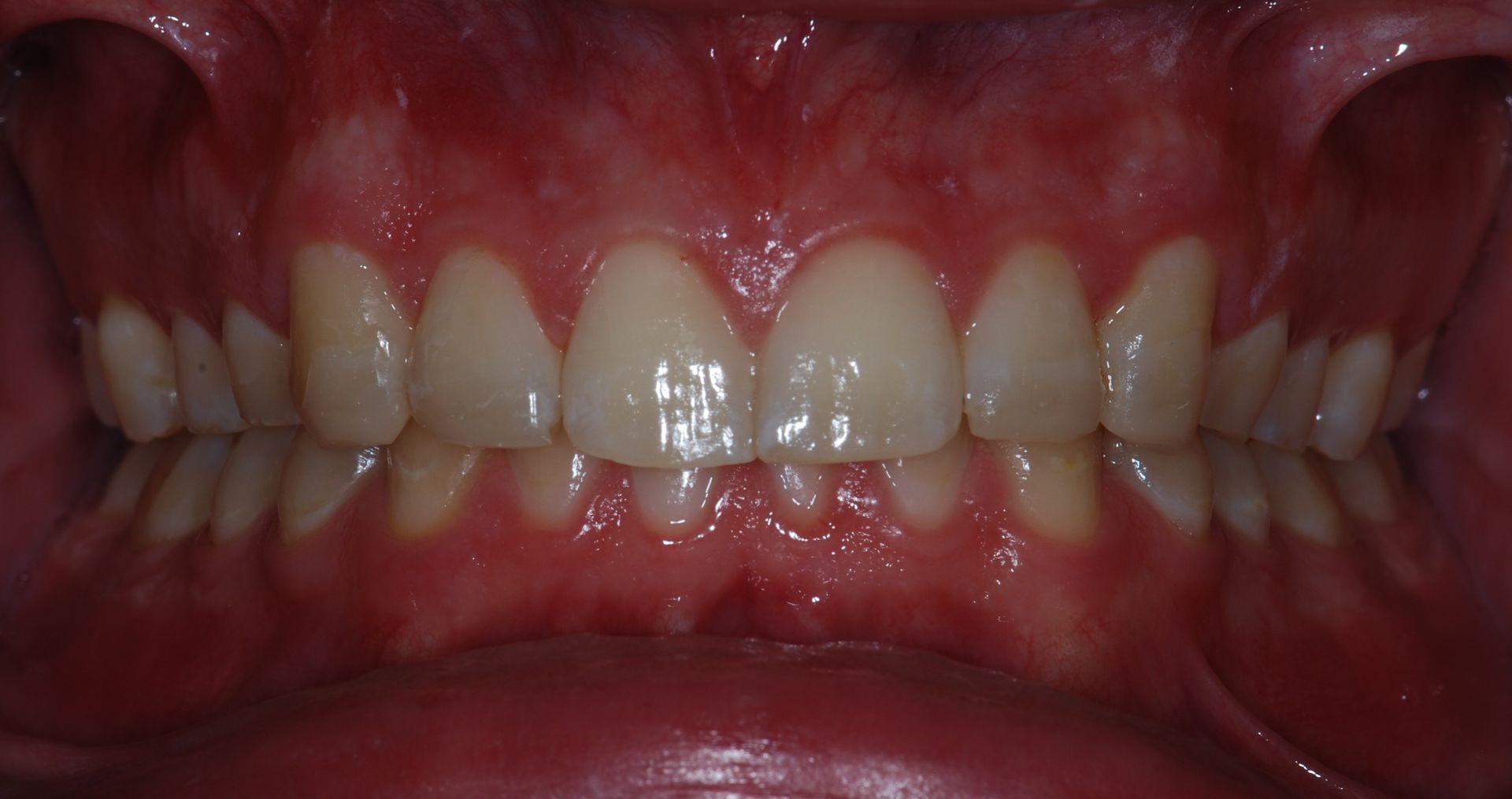 Close-up of healthy teeth, gums, and mouth. White teeth are aligned in a slightly arched row. Gums are red.