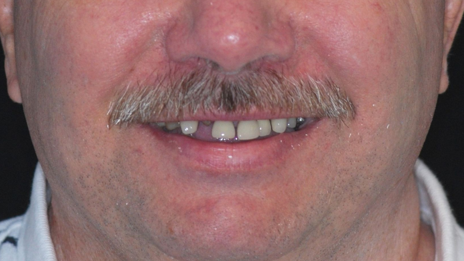 Man with mustache smiling, missing a front tooth.