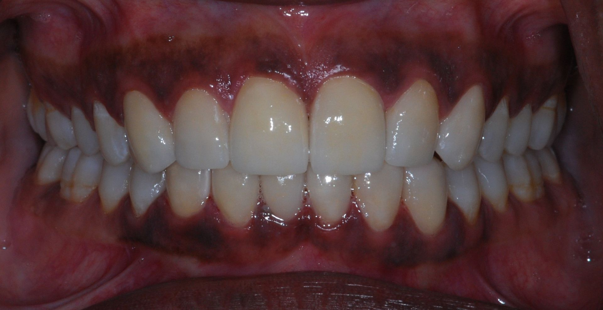 Close-up of teeth with dark gums and yellowing teeth.