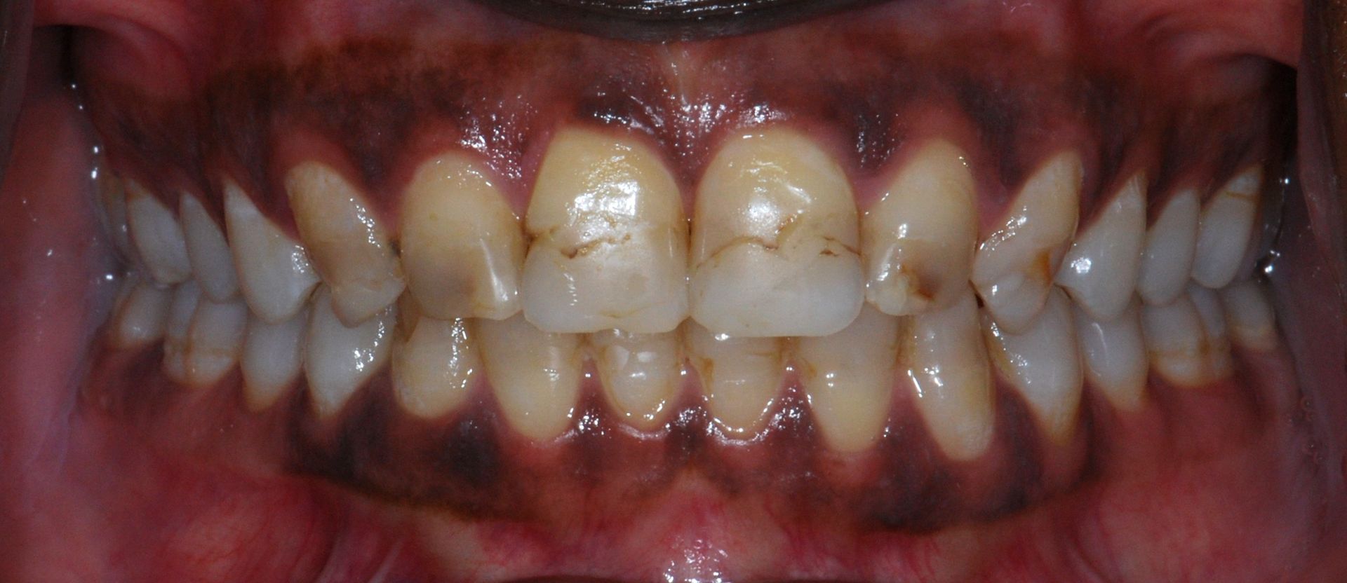 Close-up of a person's teeth. They are white, well-aligned, and surrounded by dark red gums.